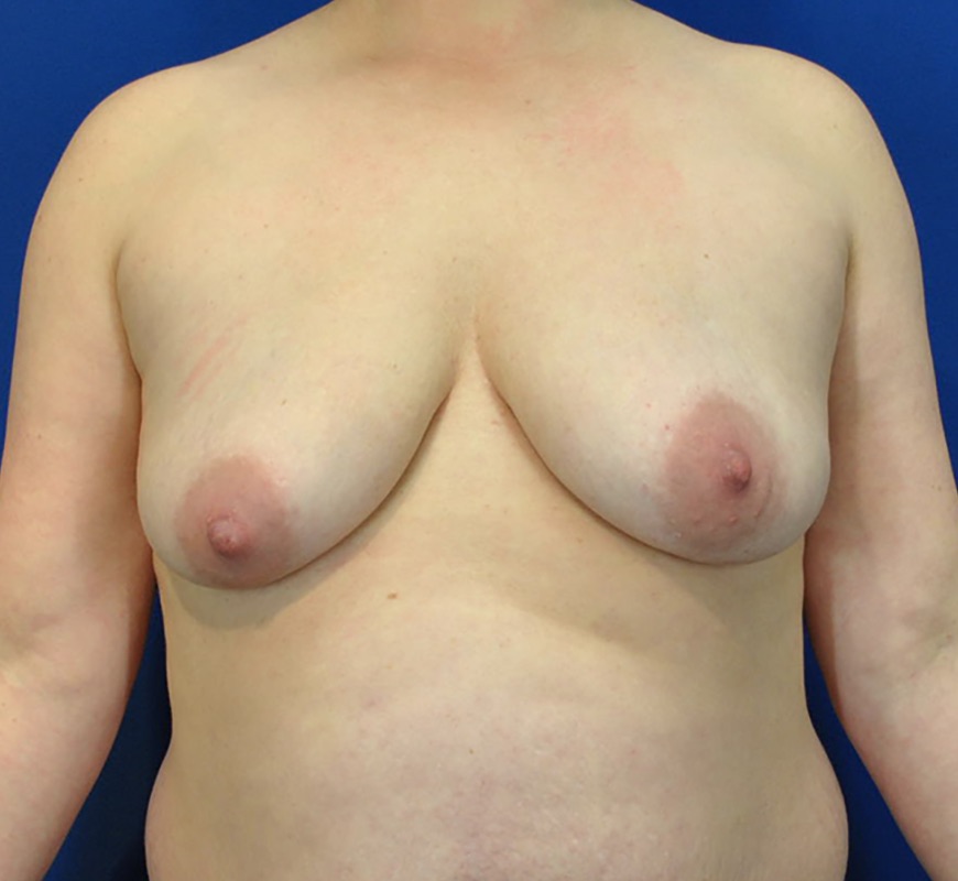 Breast Augmentation Mastopexy Before & After Image