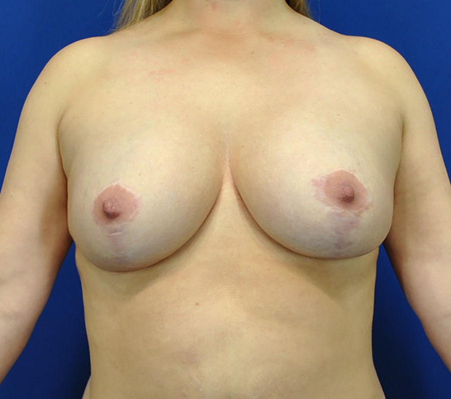 Breast Augmentation Mastopexy Before & After Image