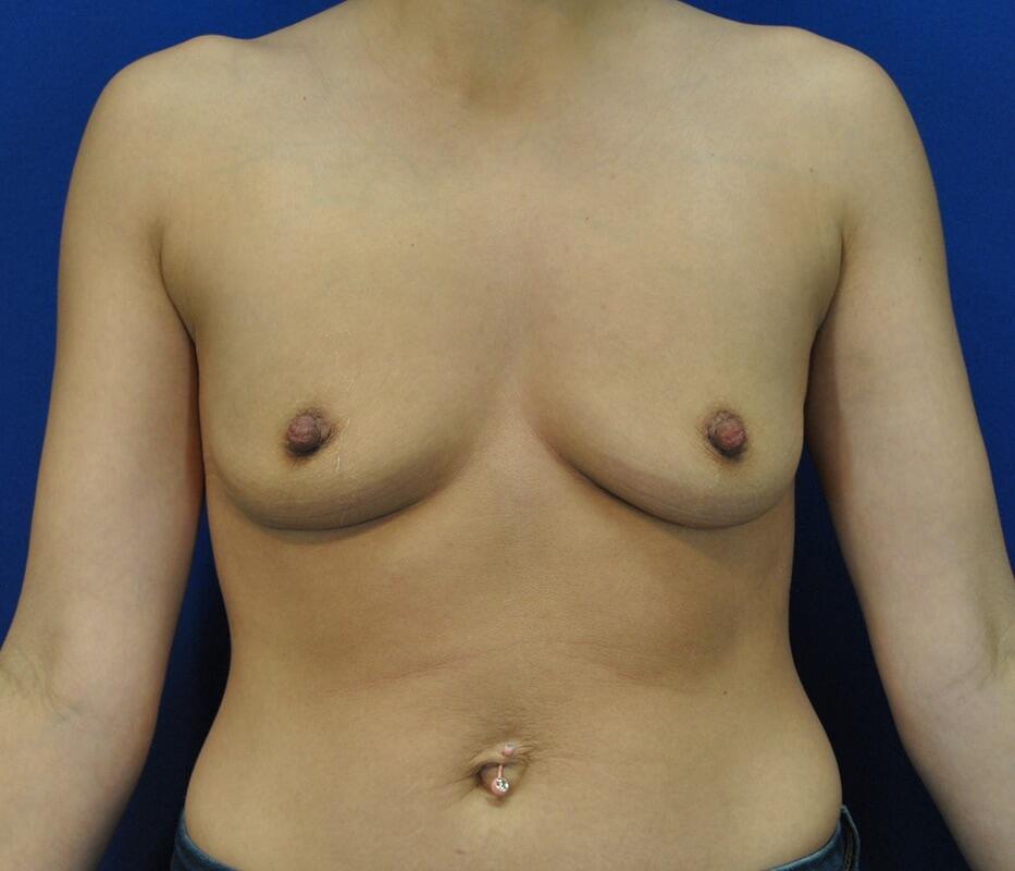 Breast Augmentation Before & After Image