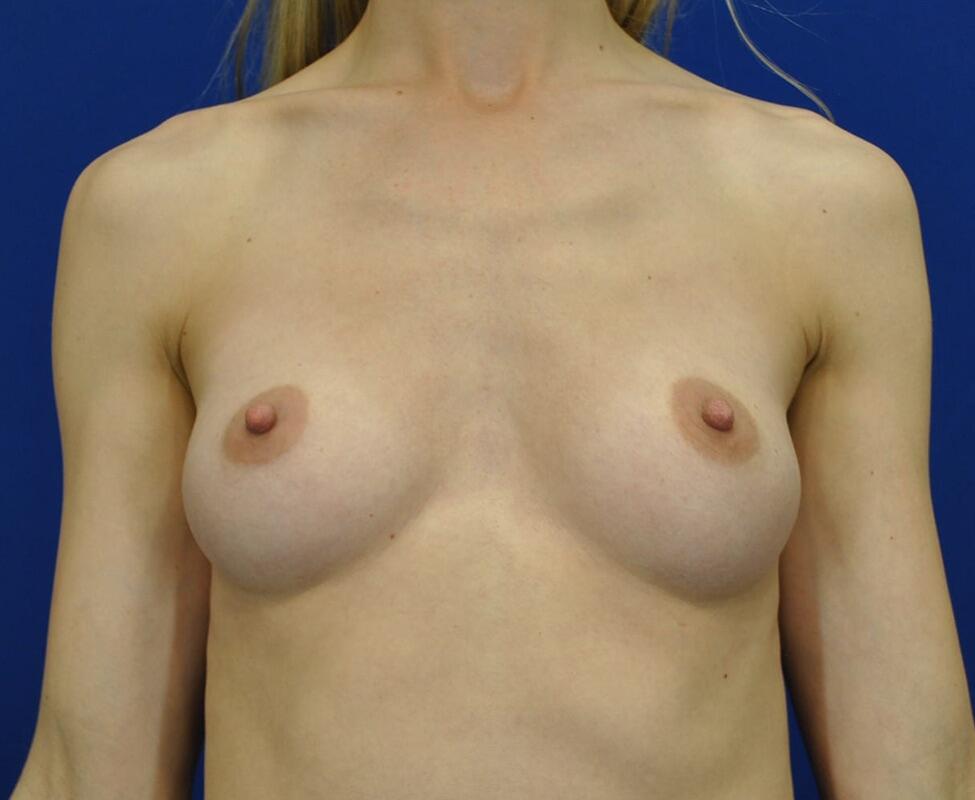 Breast Augmentation Before & After Image