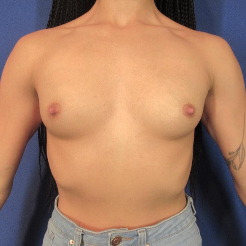 Breast Augmentation Before & After Image