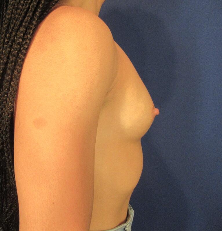 Breast Augmentation Before & After Image