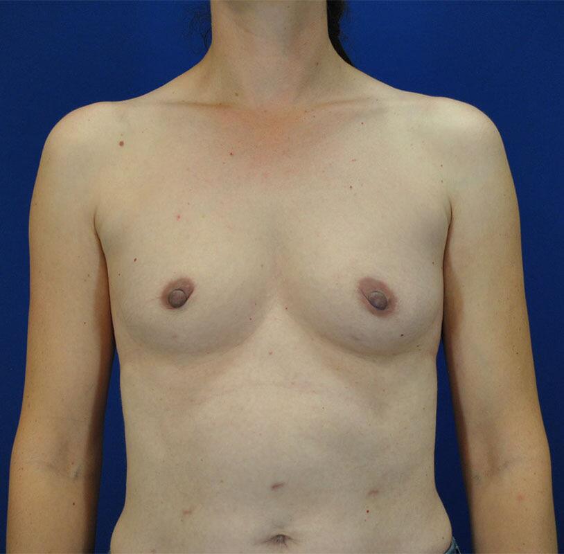 Breast Augmentation Before & After Image