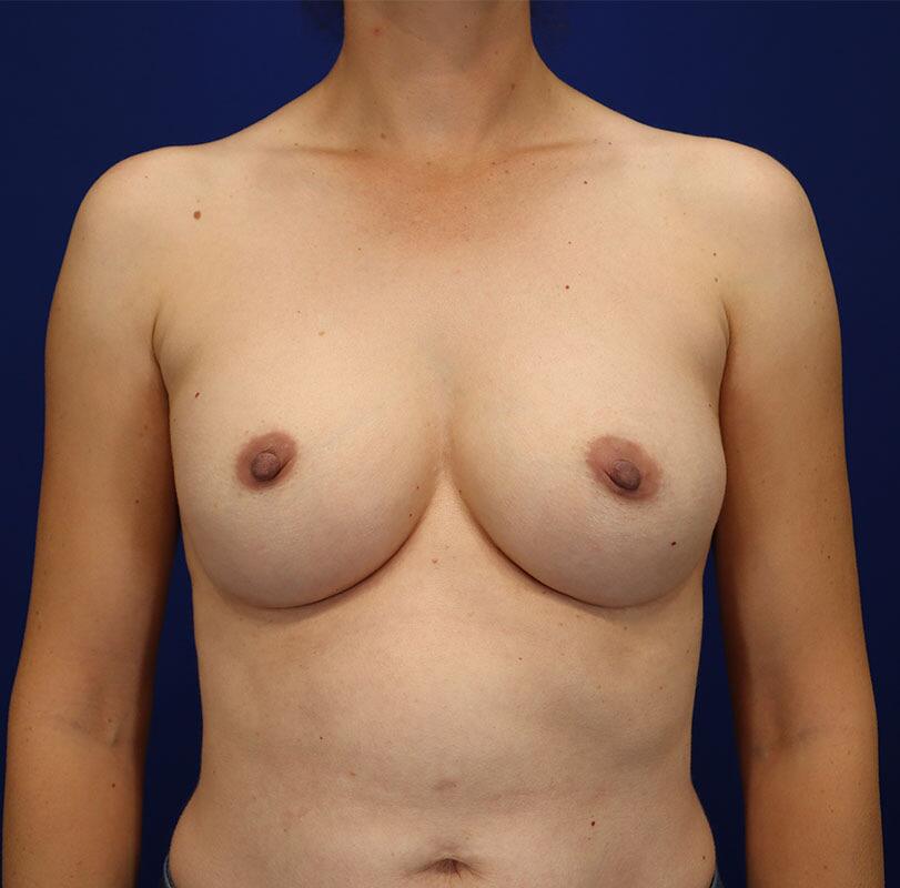 Breast Augmentation Before & After Image