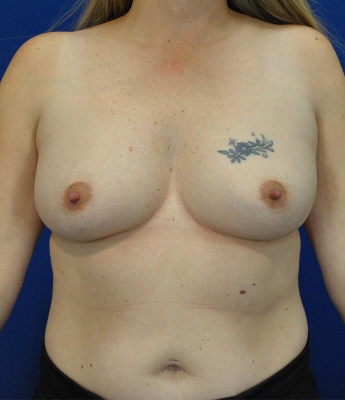 Breast Augmentation Before & After Image