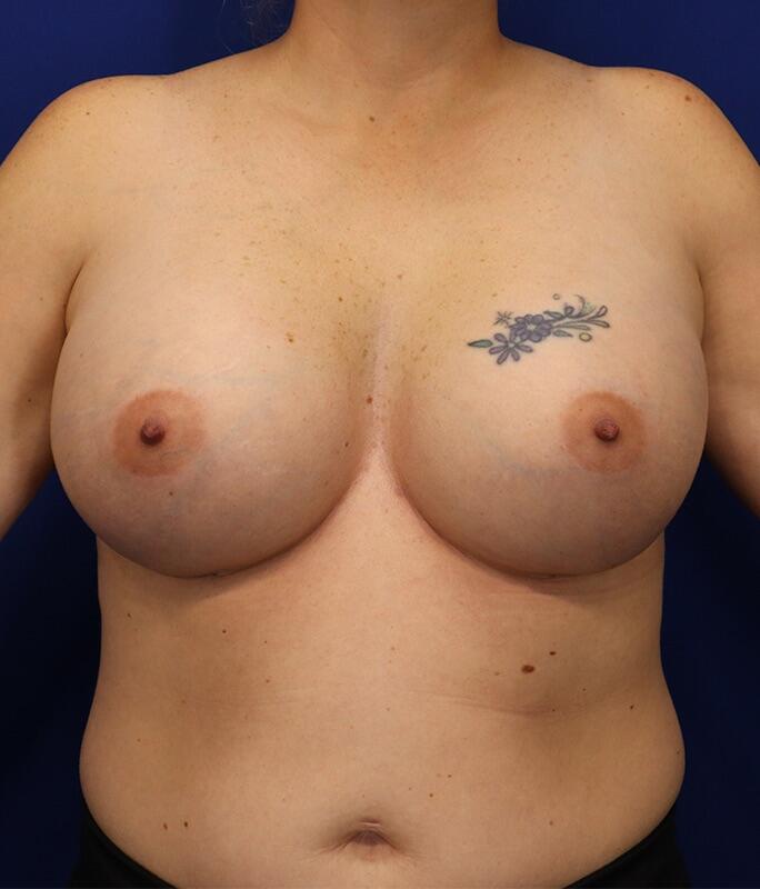 Breast Augmentation Before & After Image