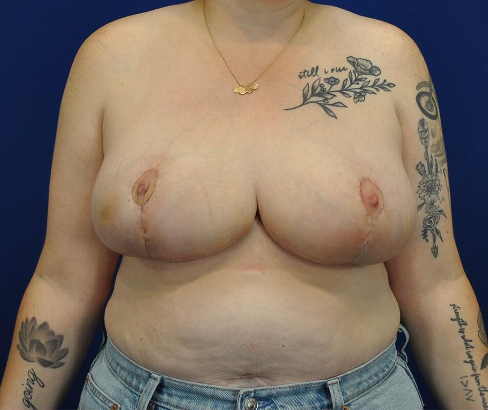 Breast Reduction Before & After Image