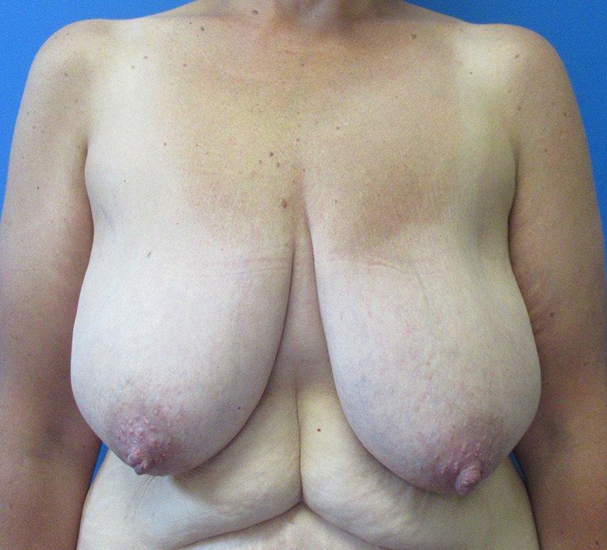 Mastopexy Before & After Image