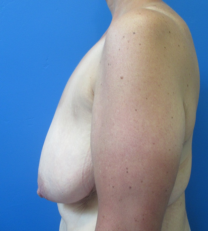 Mastopexy Before & After Image