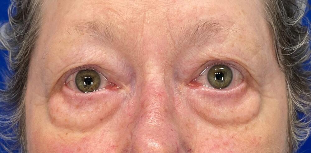 Blepharoplasty Before & After Image