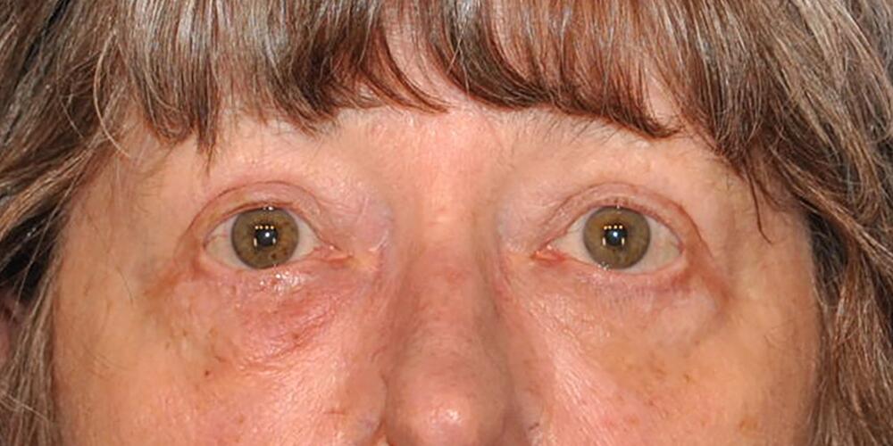 Blepharoplasty Before & After Image