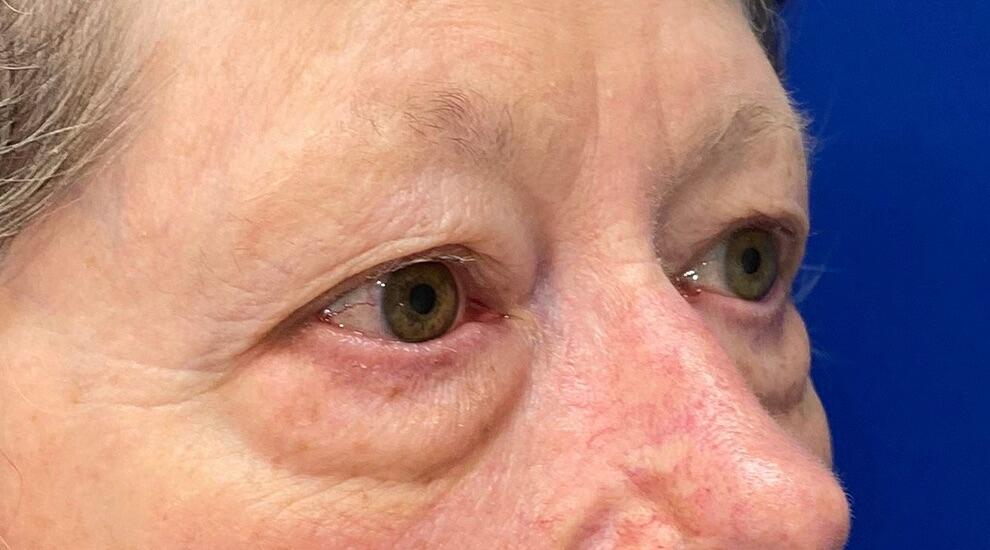 Blepharoplasty Before & After Image