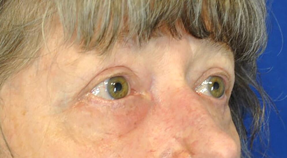 Blepharoplasty Before & After Image