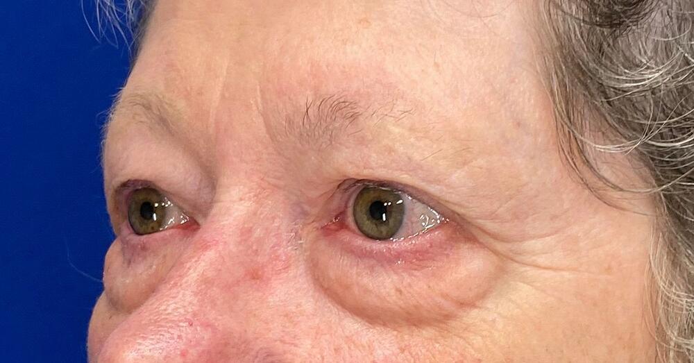 Blepharoplasty Before & After Image