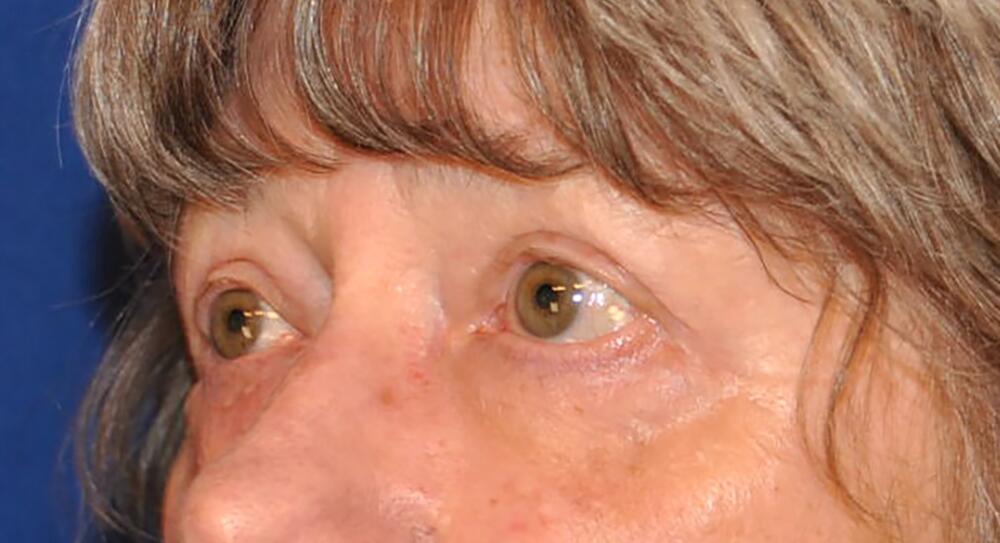 Blepharoplasty Before & After Image