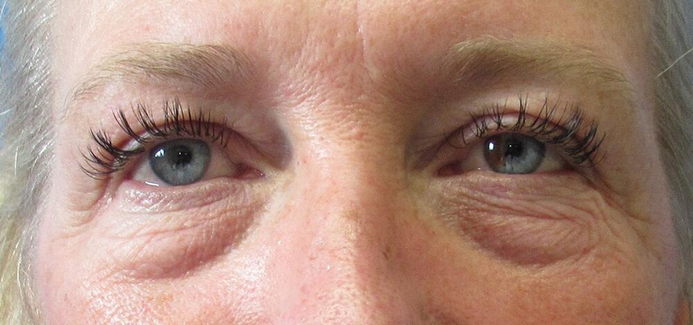 Blepharoplasty Before & After Image