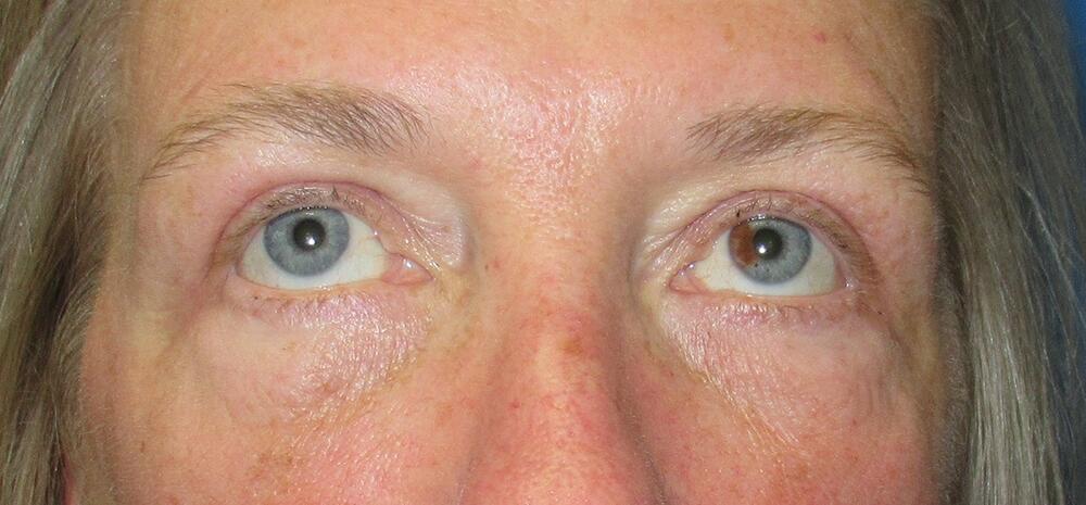 Blepharoplasty Before & After Image