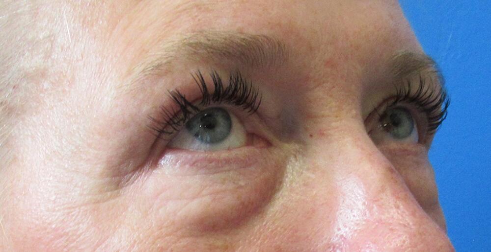 Blepharoplasty Before & After Image