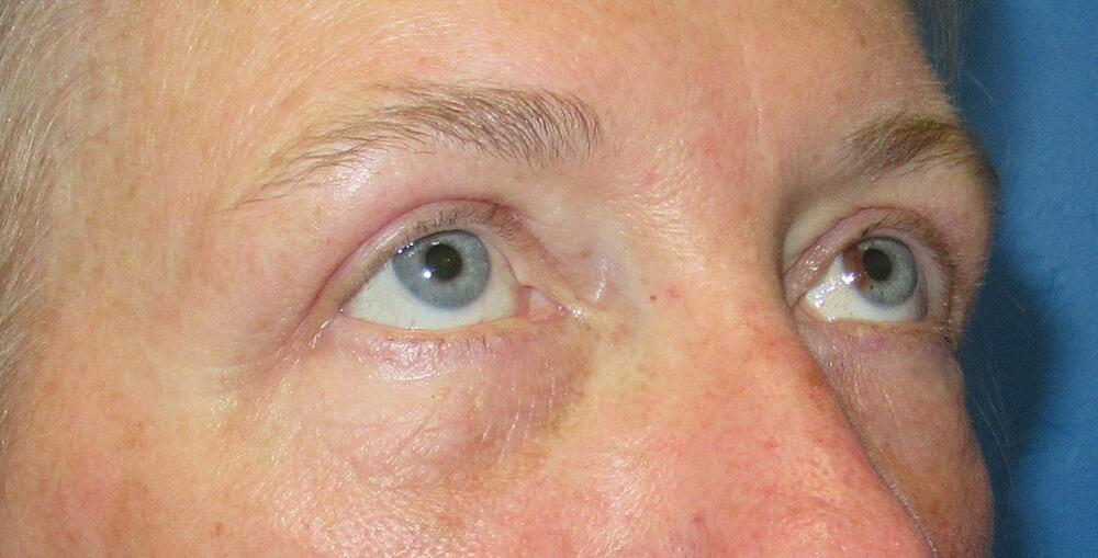 Blepharoplasty Before & After Image