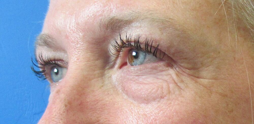 Blepharoplasty Before & After Image