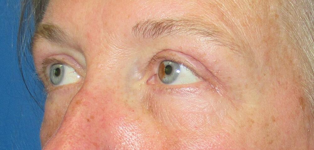 Blepharoplasty Before & After Image