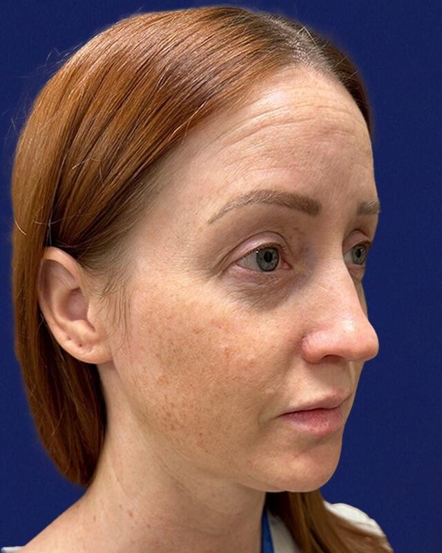 Jawline Contouring Before & After Image