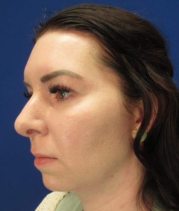 Jawline Contouring Before & After Image