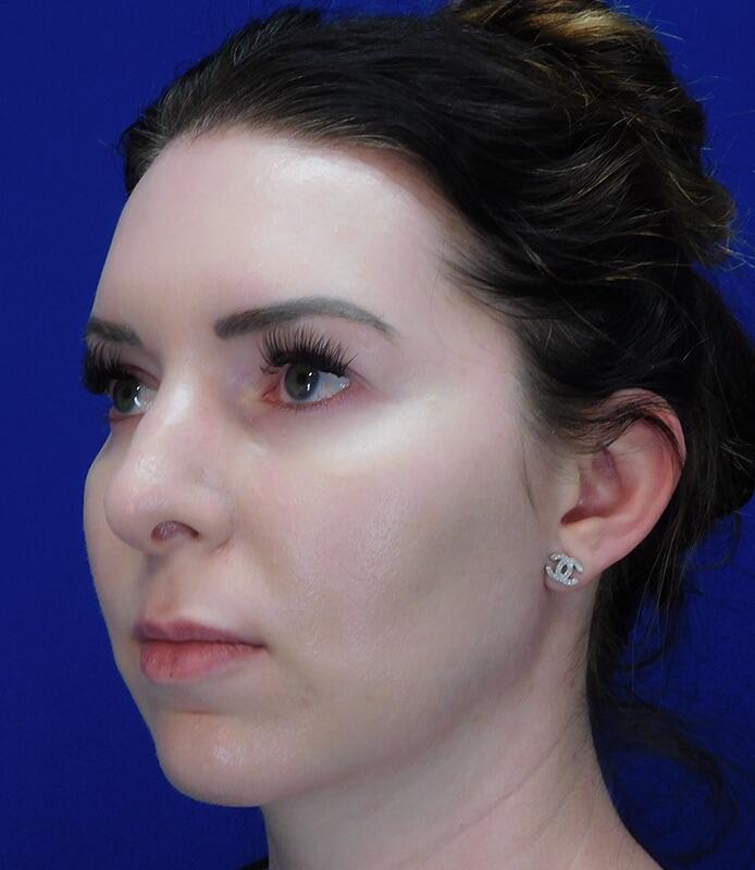 Jawline Contouring Before & After Image