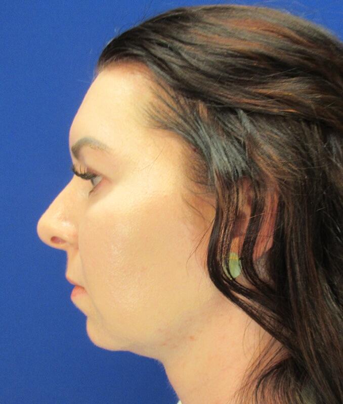 Jawline Contouring Before & After Image