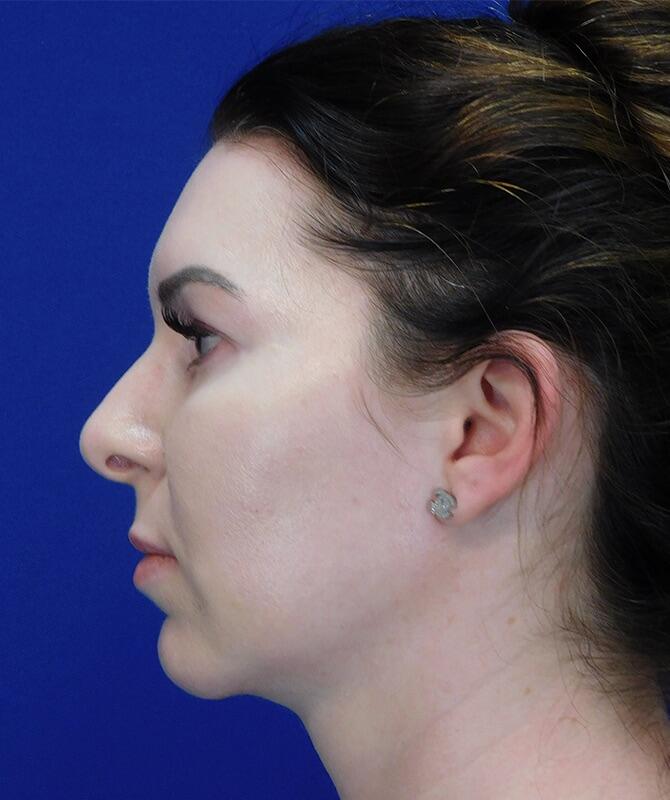 Jawline Contouring Before & After Image