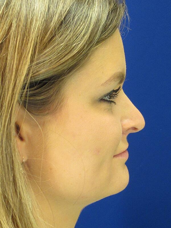 Rhinoplasty Before & After Image