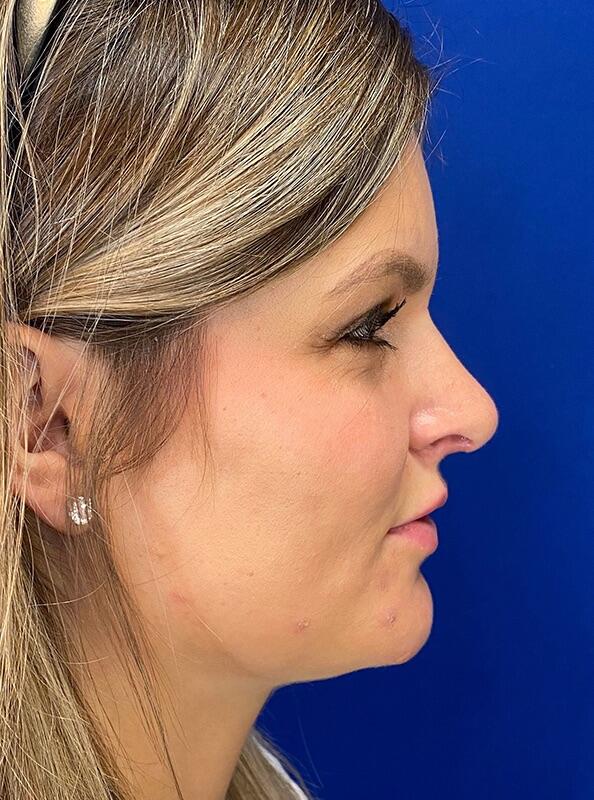 Rhinoplasty Before & After Image