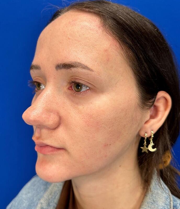 Rhinoplasty Before & After Image