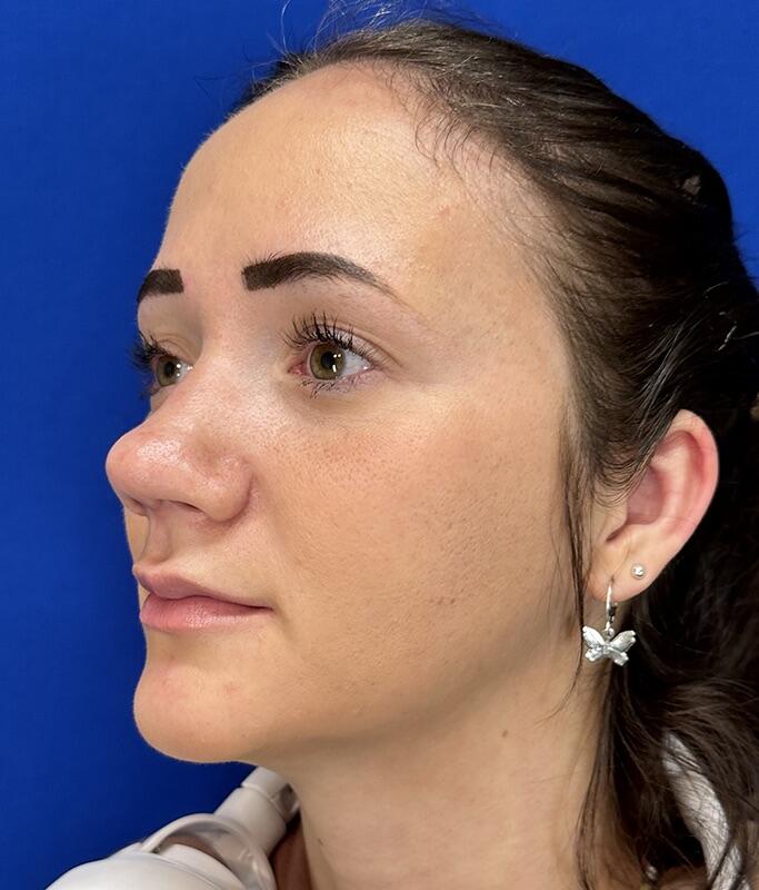 Rhinoplasty Before & After Image