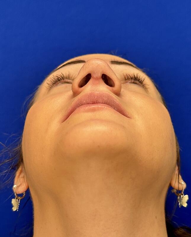 Rhinoplasty Before & After Image