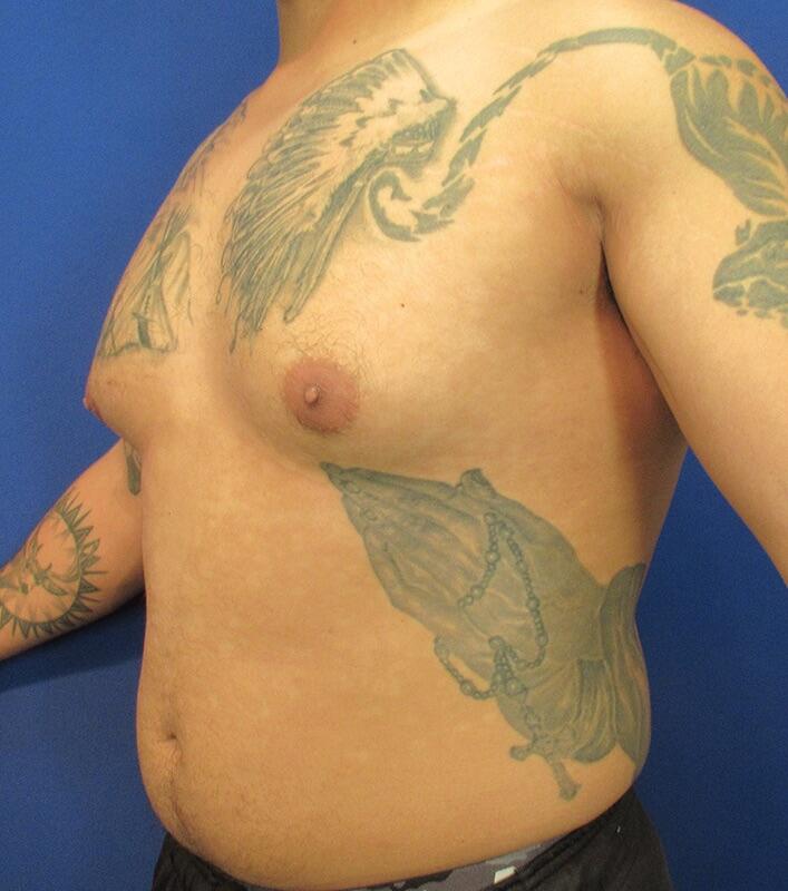 Gynecomastia Before & After Image