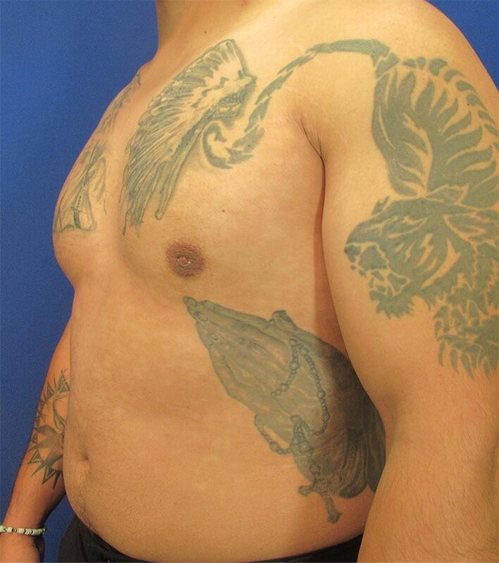 Gynecomastia Before & After Image