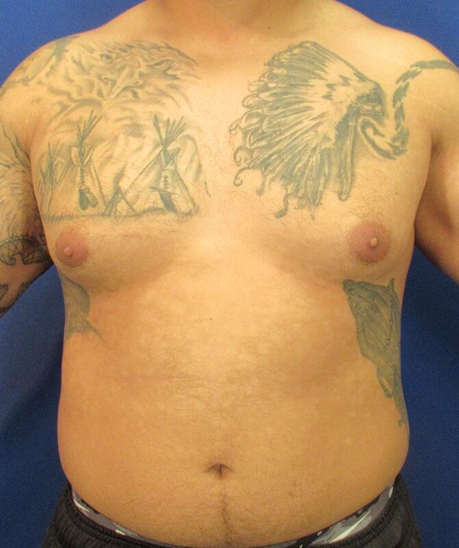 Gynecomastia Before & After Image