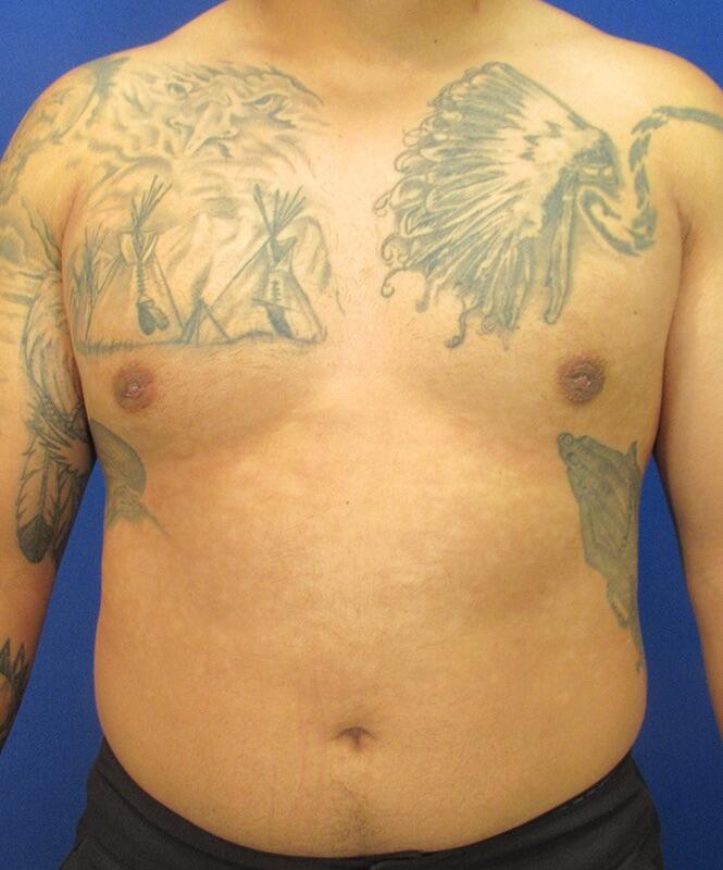 Gynecomastia Before & After Image