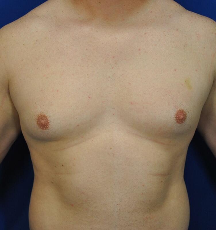 Gynecomastia Before & After Image