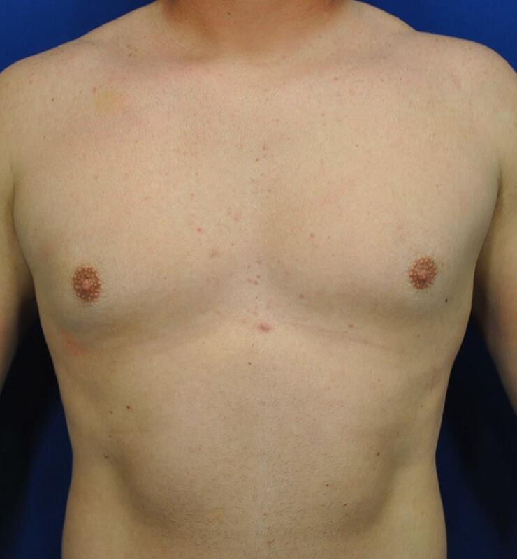 Gynecomastia Before & After Image