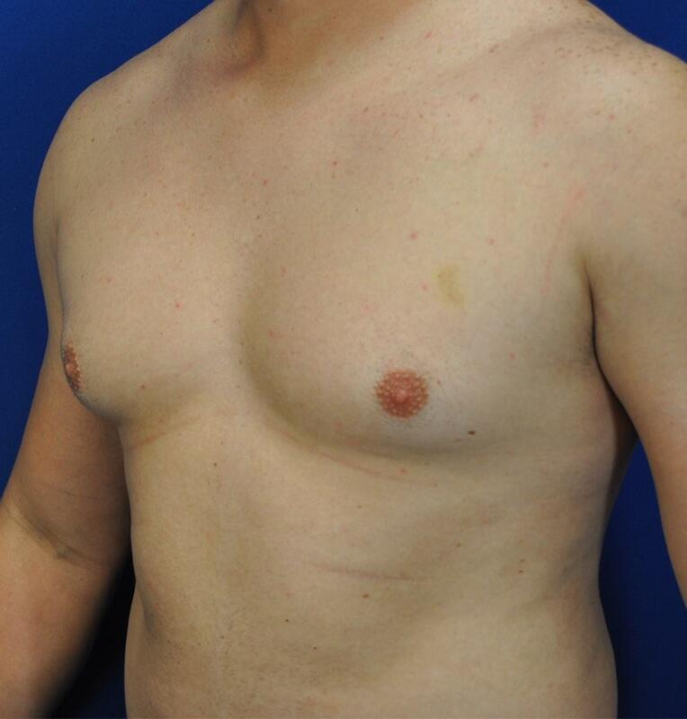 Gynecomastia Before & After Image