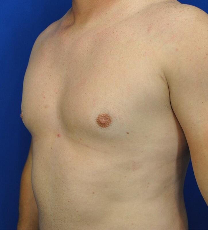 Gynecomastia Before & After Image