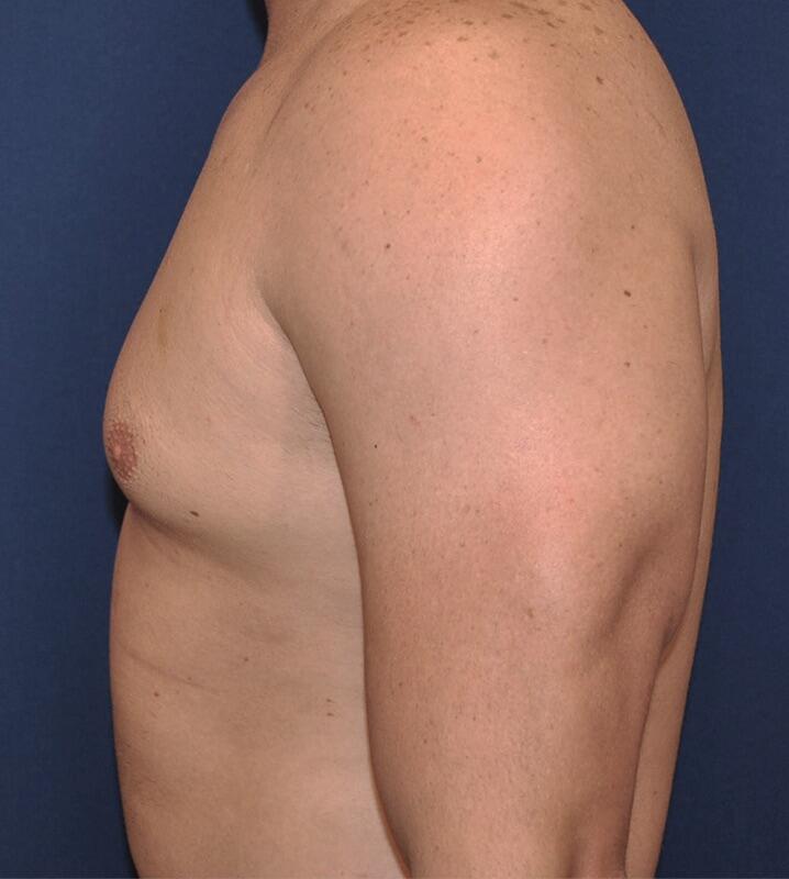 Gynecomastia Before & After Image