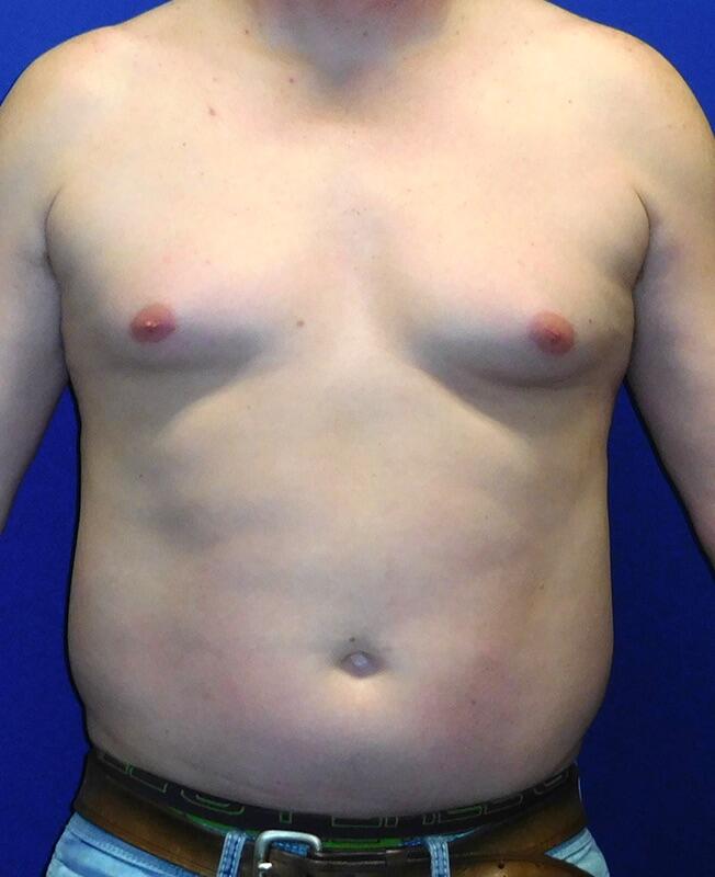 Gynecomastia Before & After Image