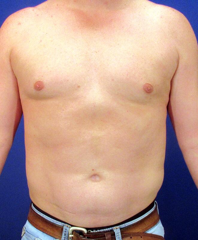 Gynecomastia Before & After Image