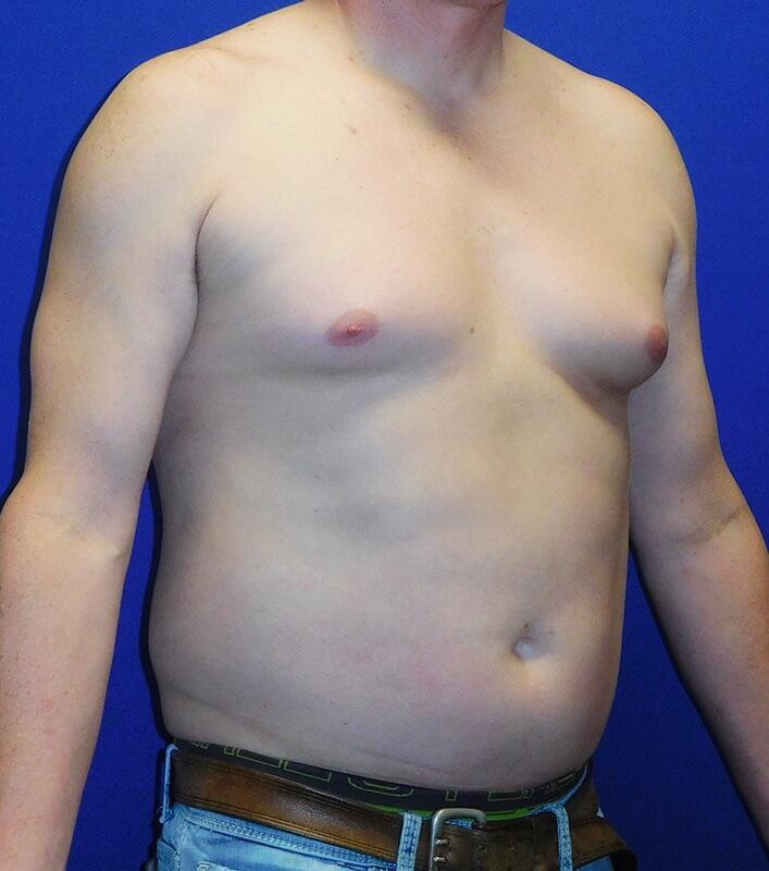 Gynecomastia Before & After Image