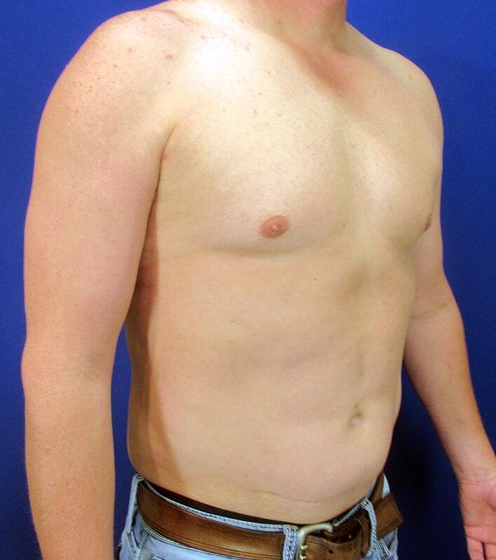 Gynecomastia Before & After Image