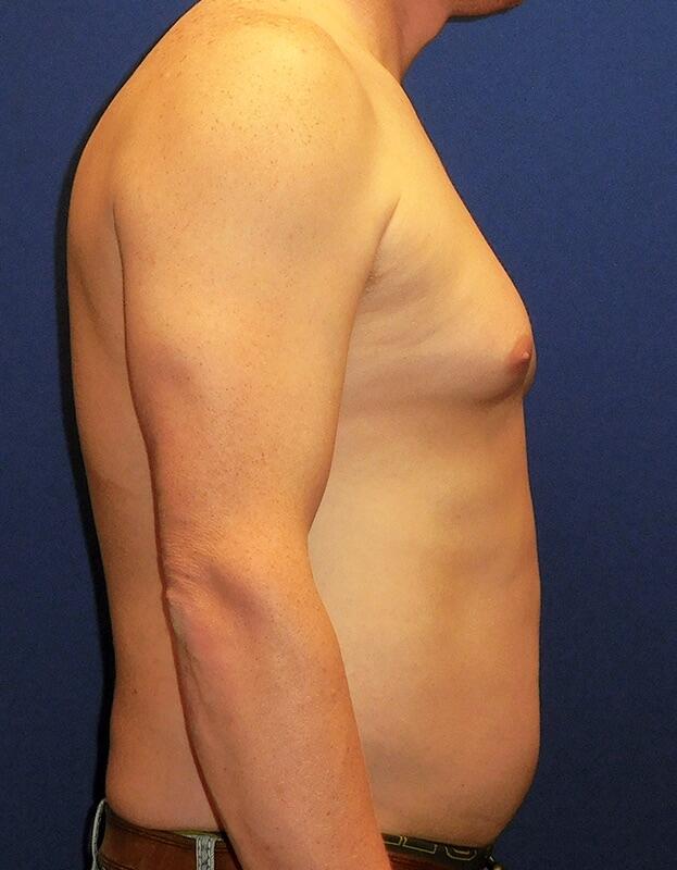 Gynecomastia Before & After Image