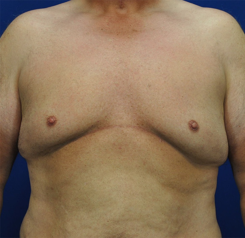 Gynecomastia Before & After Image